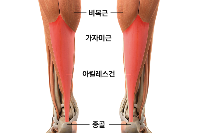 아킬레스건
