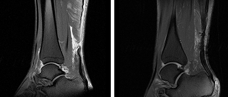 아킬레스건파열