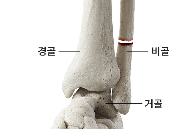 발목골절