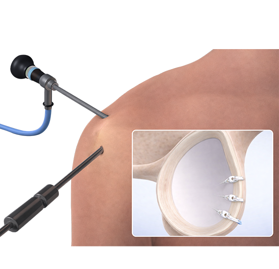 전방관절와순파열