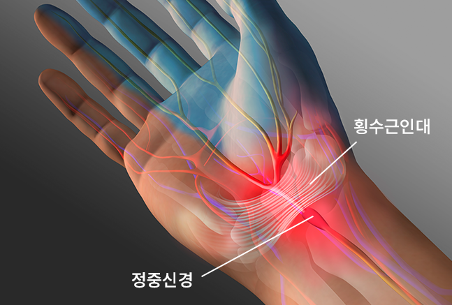 손목터널증후군