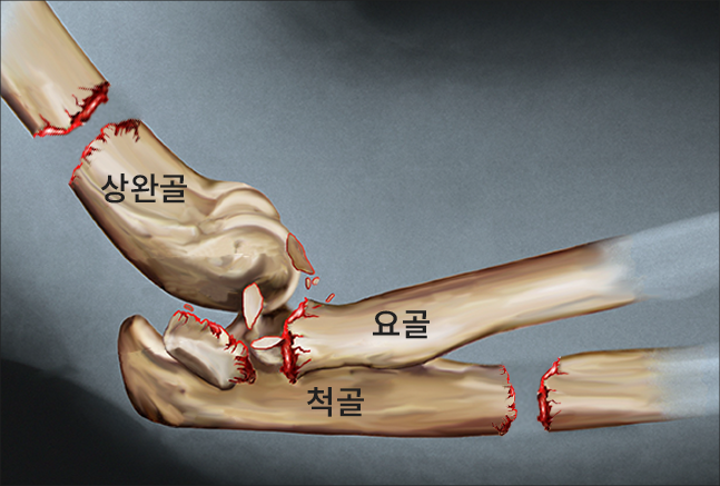 팔꿈치 골절