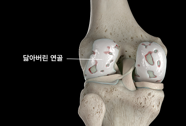 무릎퇴행성관절염