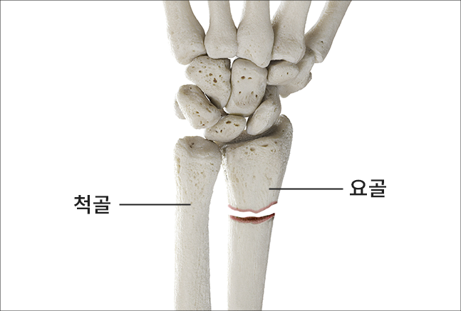 손목골절
